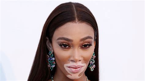 winnie harlow skin change